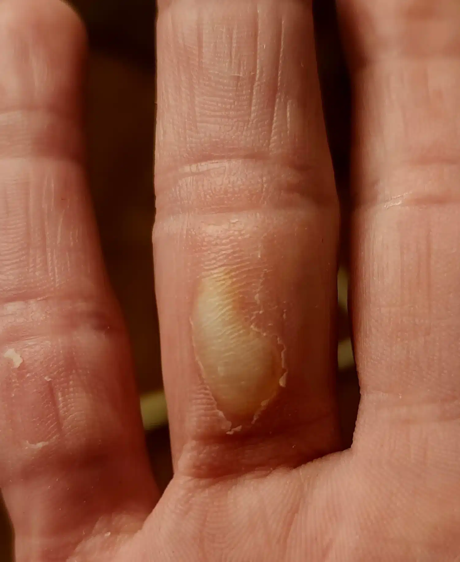 Burns caused by the cold